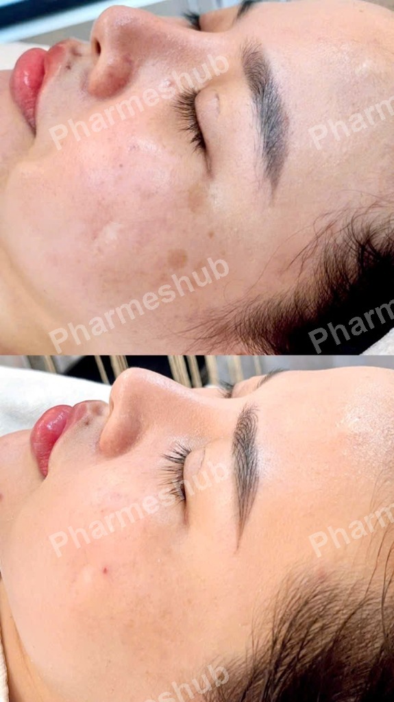 Kết quả phục hồi da nám mảng Quỳnh Trang Pharmeshub - Góc mặt bên